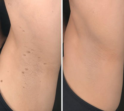 PURESHADE® Maximálně silné náplasti na odstranění bradavic 💧 Cílená péče pro běžné bradavice, plantární bradavice a kožní výrůstky | Jednoduché domácí použití