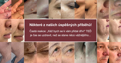 PURESHADE® Maximálně silné náplasti na odstranění bradavic 💧 Cílená péče pro běžné bradavice, plantární bradavice a kožní výrůstky | Jednoduché domácí použití